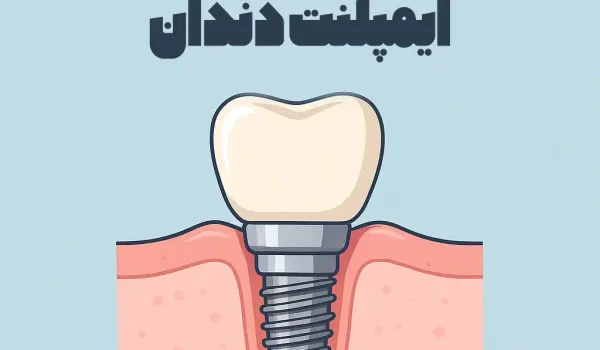 15 سوال مهم درباره ی ایمپلنت دندان