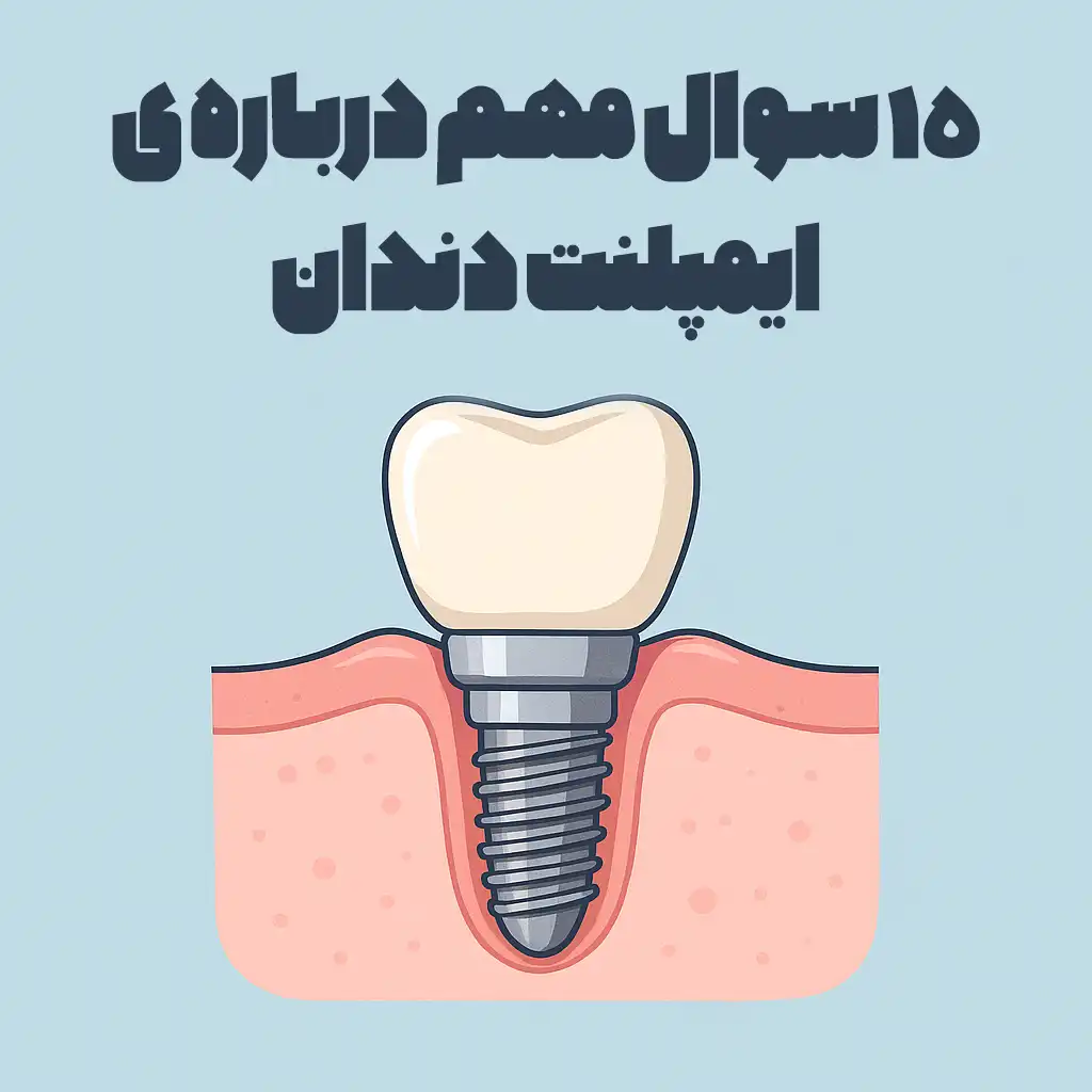 15 سوال مهم درباره ی ایمپلنت دندان