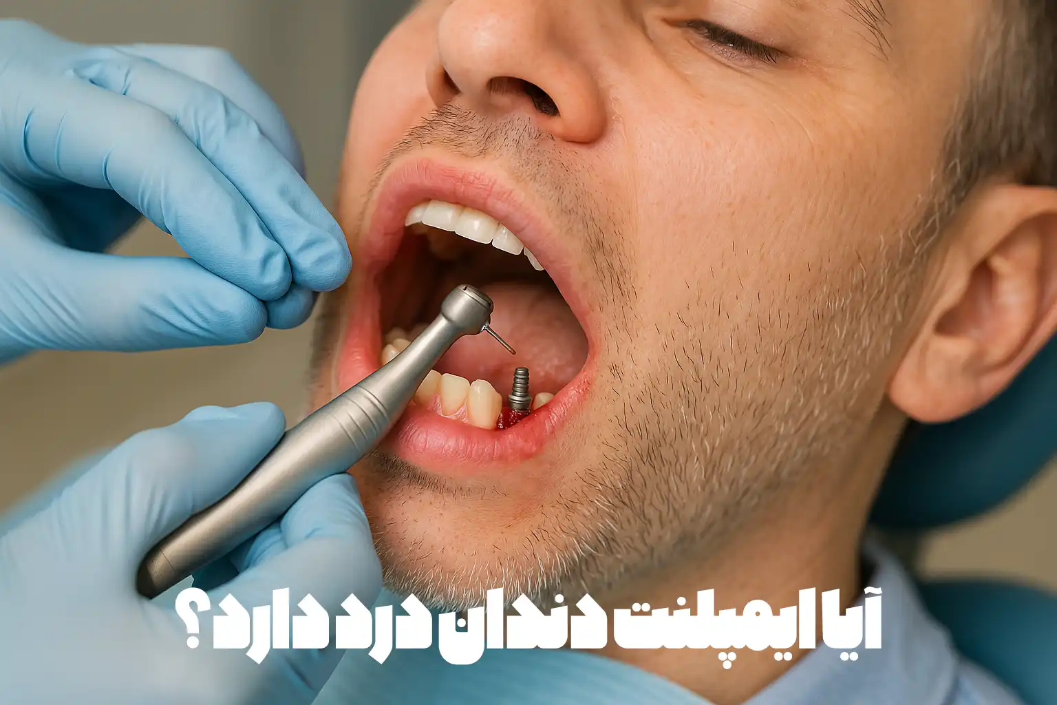 آیا ایمپلنت دندان درد دارد؟
