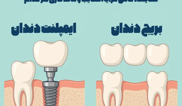 ایمپلنت دندان یا بریج