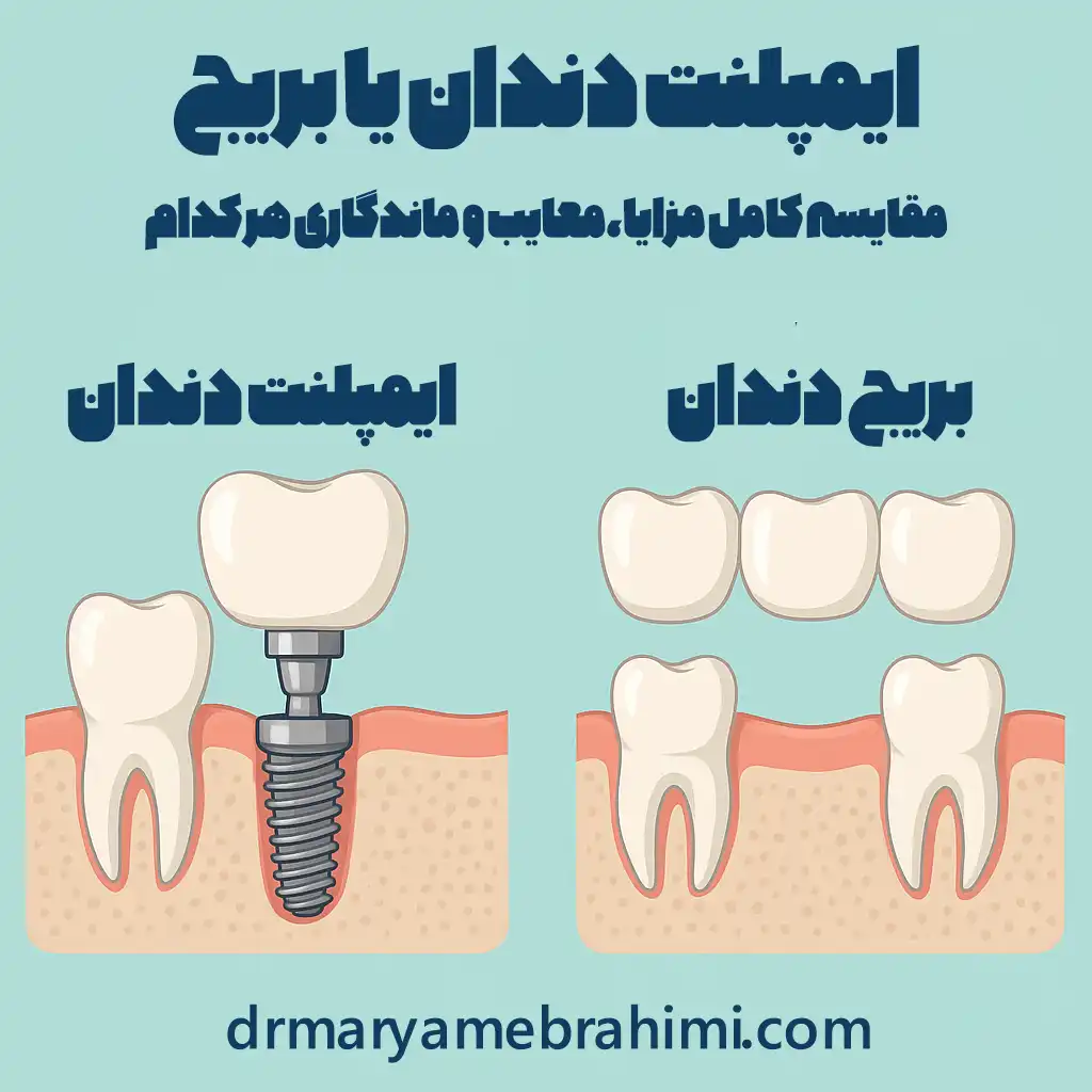 ایمپلنت دندان یا بریج
